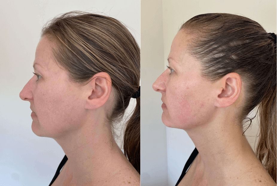 Avant apr&egrave;s programme visage pro-aging &agrave; Neuilly &mdash; ovale du visage redessin&eacute;