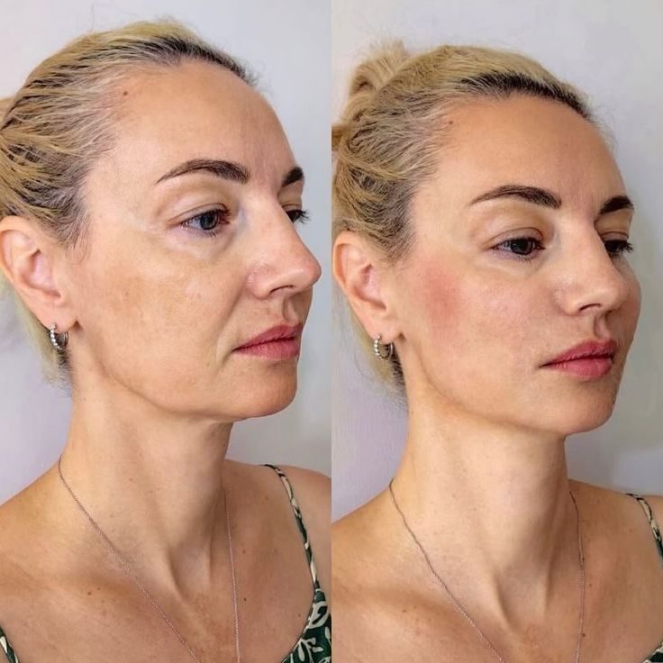 Avant apr&egrave;s soin visage anti-&acirc;ge naturel &mdash; raffermissement sans injection