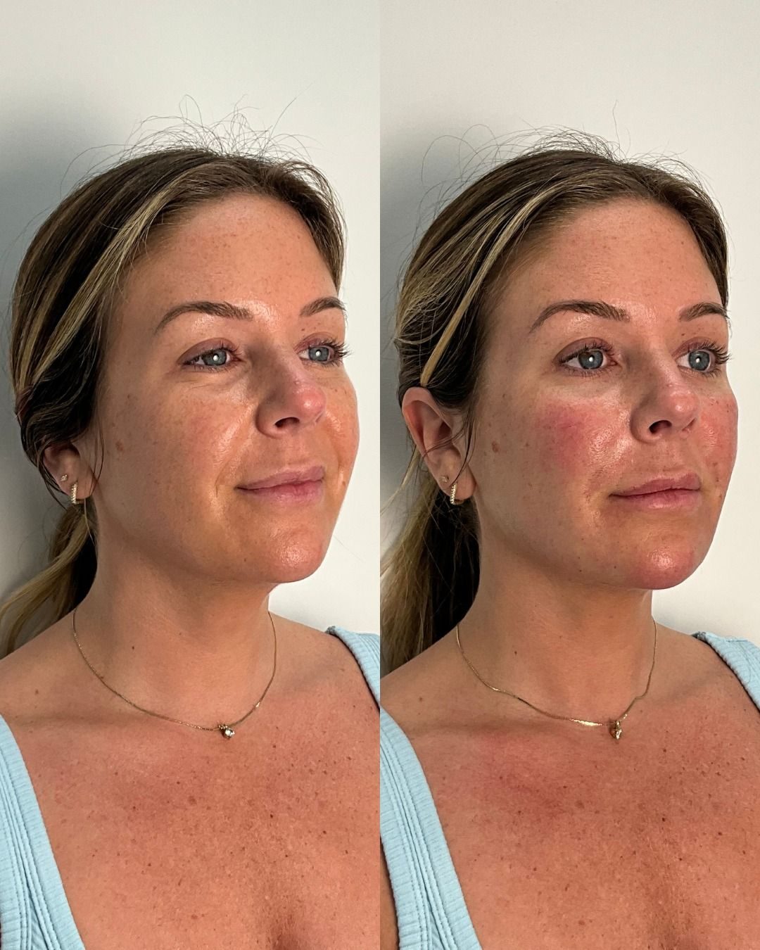 Avant apr&egrave;s lifting naturel du visage &mdash; traits repos&eacute;s et &eacute;clat