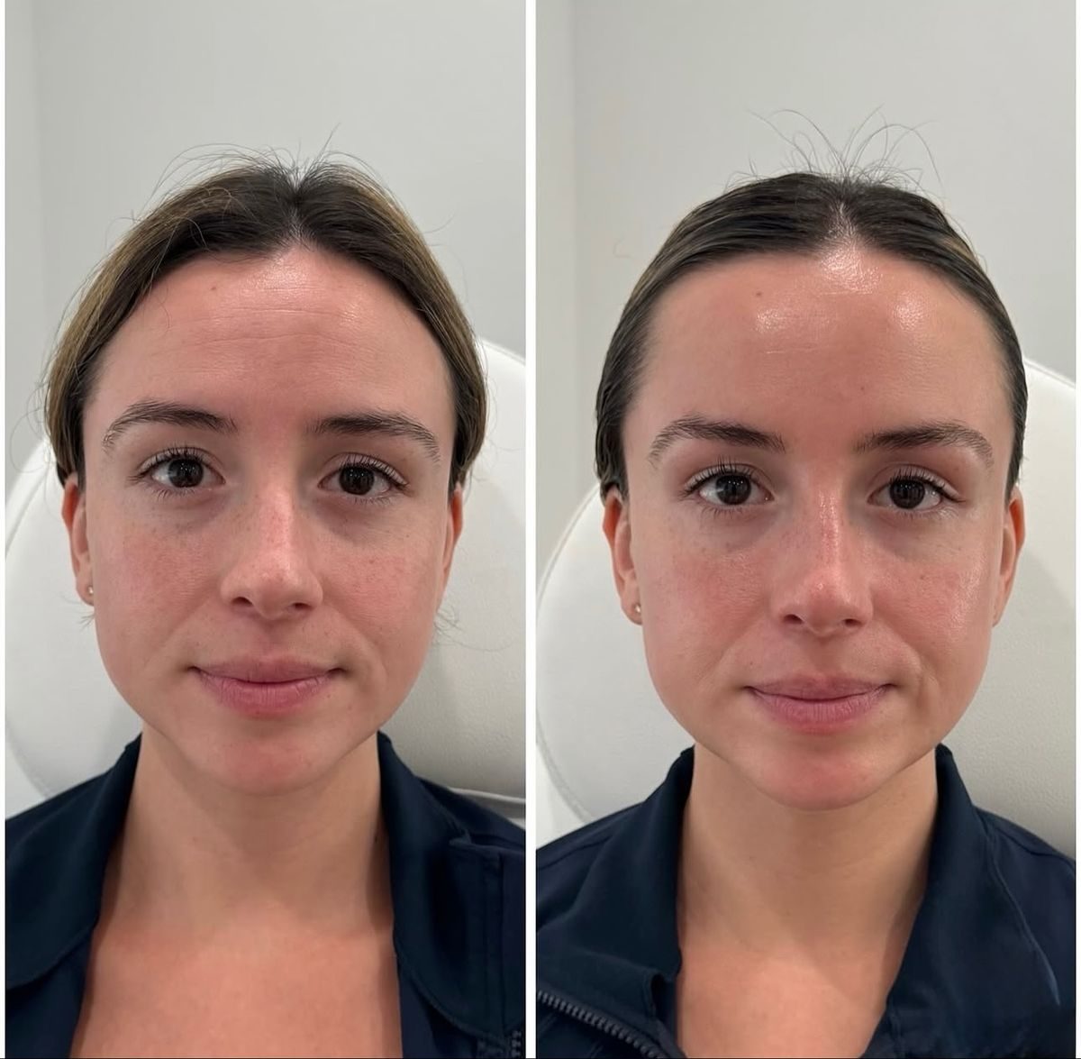 Avant après lifting manuel du visage — contours liftés, Neuilly-sur-Seine & Paris