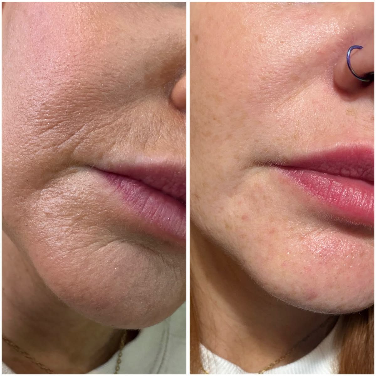 Biostimulation du collagène avant après — rides péribuccales et fermeté du bas du visage, Paris