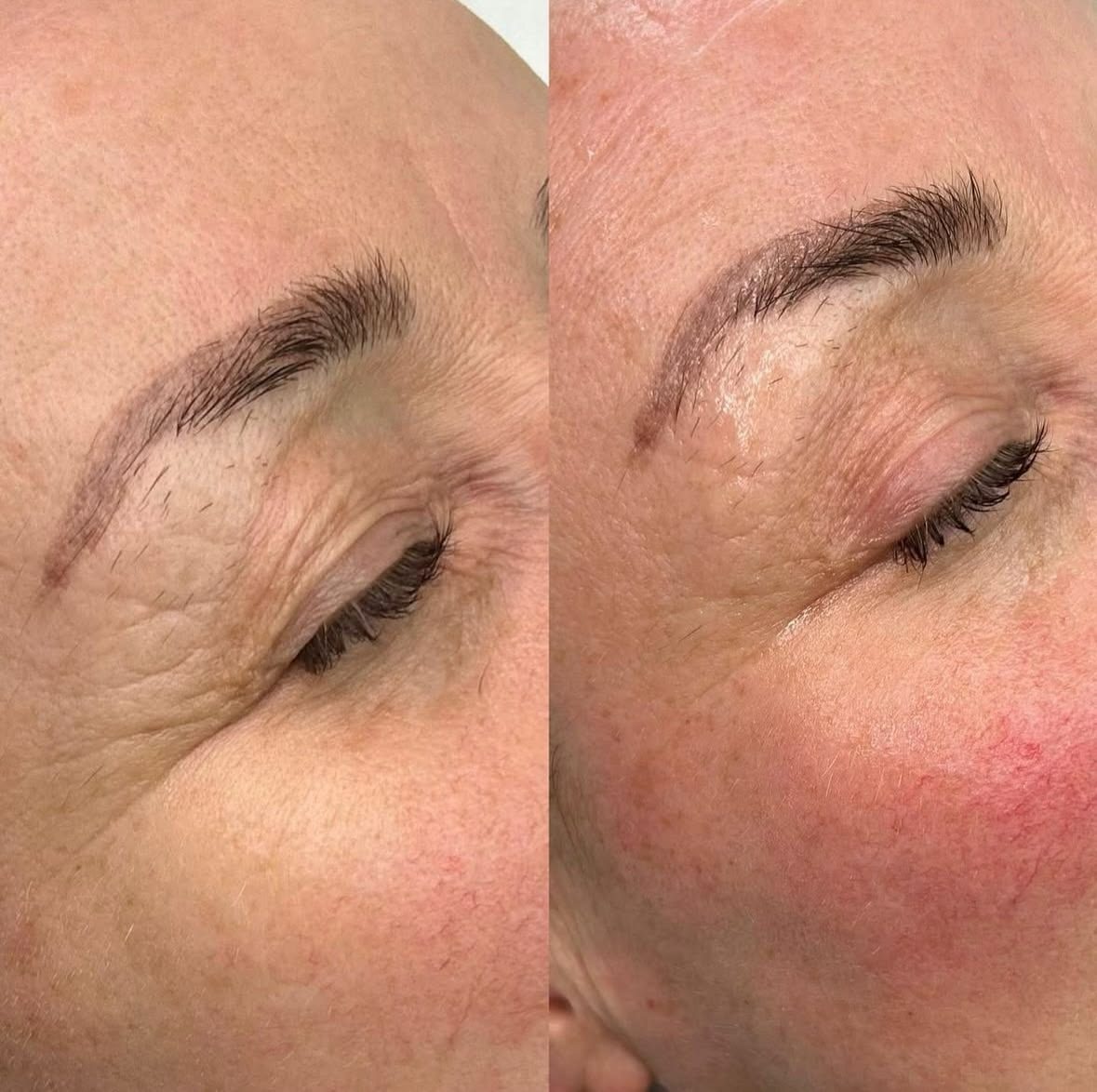Biostimulation du collagène avant après — rides patte d'oie et contour de l'œil lissés, Neuilly