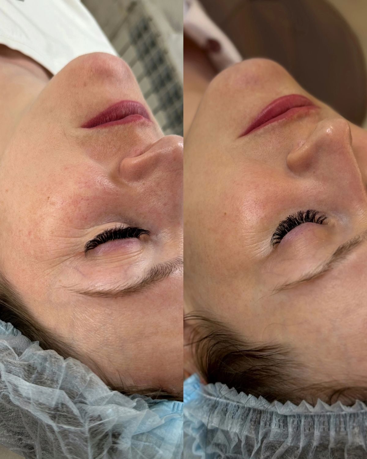 Biostimulation du collagène avant après — ridules du contour de l'œil et fermeté, Neuilly-sur-Seine