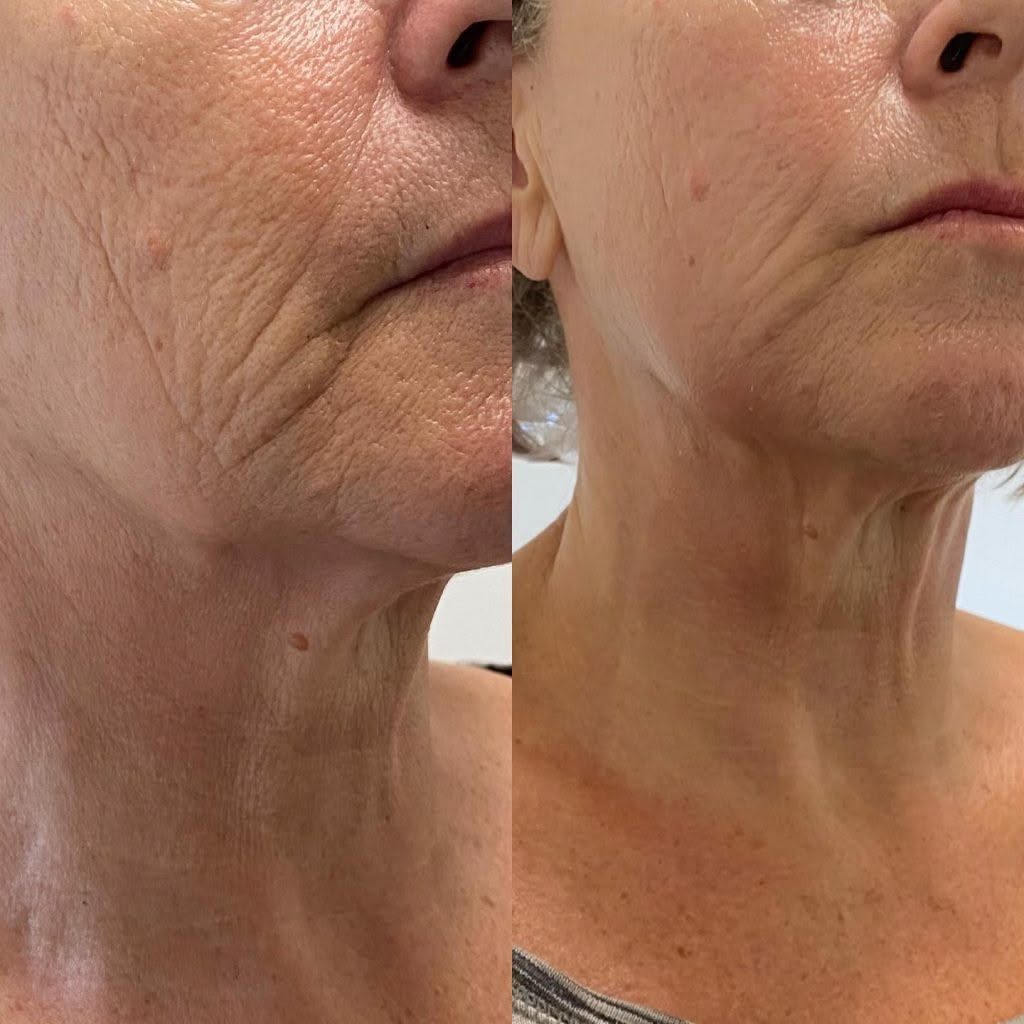 Avant apr&egrave;s oxyg&eacute;noth&eacute;rapie du visage &mdash; &eacute;clat et r&eacute;g&eacute;n&eacute;ration