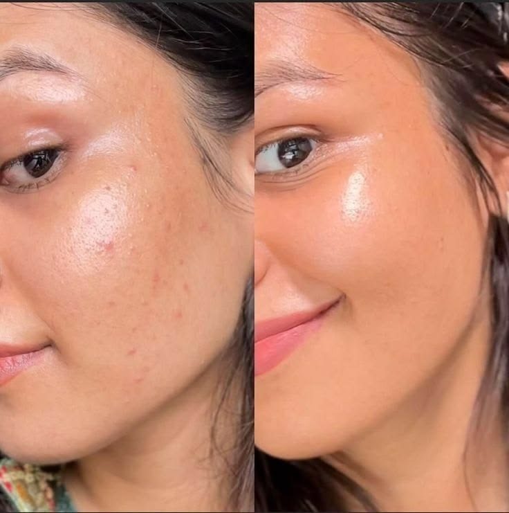 Avant après soin oxygène visage — teint lumineux, grain de peau affiné, Neuilly-sur-Seine & Paris