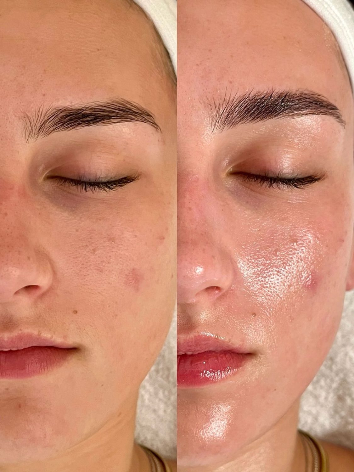 Avant après soin oxygène visage — peau à tendance acnéique, pores resserrés, Neuilly-sur-Seine & Paris