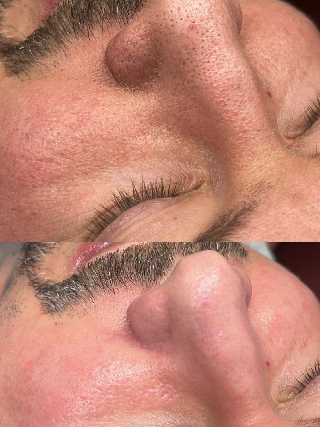 Avant après soin oxygène visage — grain de peau affiné et pores resserrés, Neuilly-sur-Seine & Paris