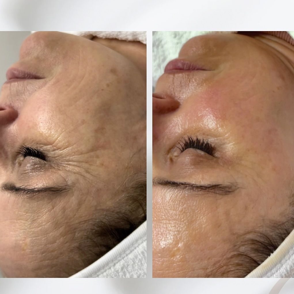 Avant après soin oxygène visage — rides lissées et fermeté du contour de l'œil, Neuilly-sur-Seine & Paris