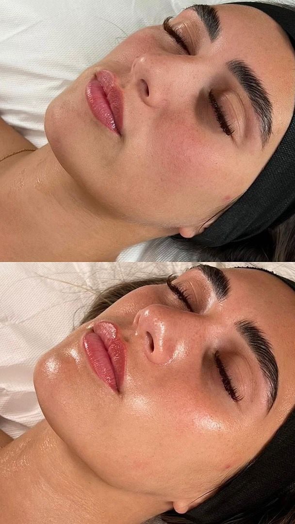 Avant après soin Glass Skin — effet miroir et peau repulpée, Neuilly-sur-Seine & Paris
