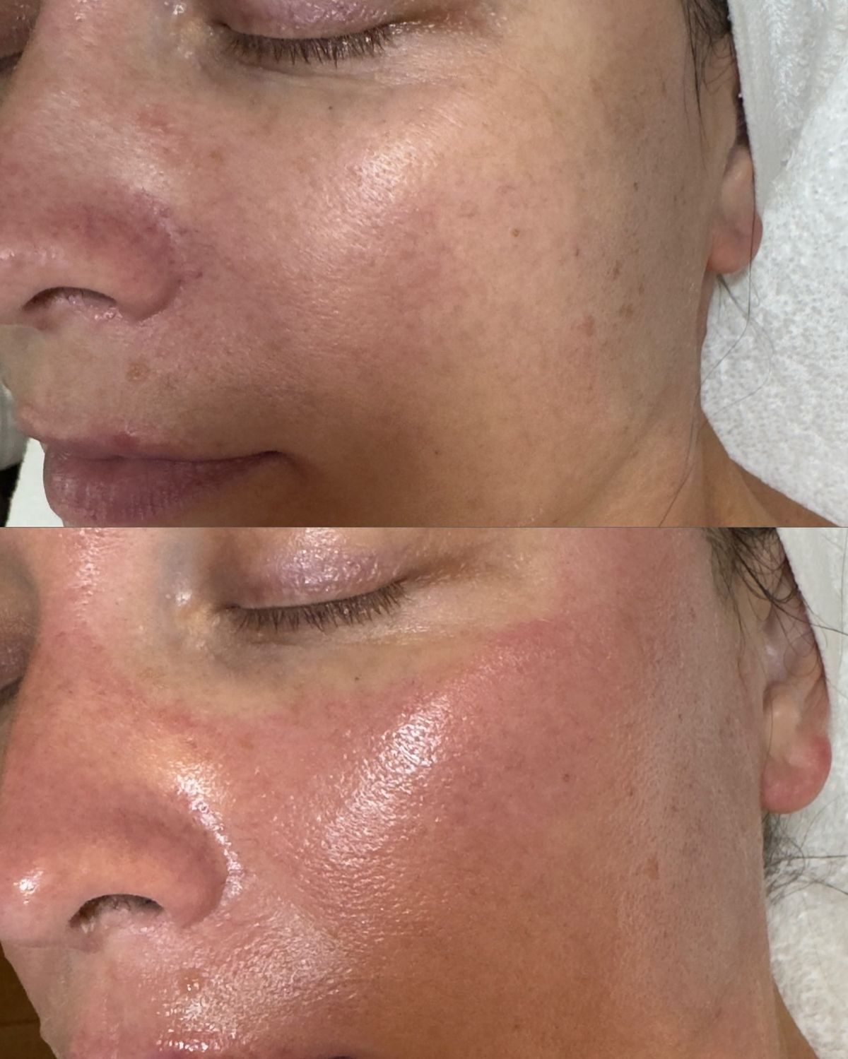 Avant après soin Glass Skin — taches atténuées et éclat, Neuilly-sur-Seine & Paris