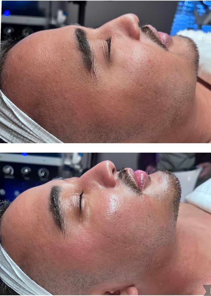 Avant après soin Glass Skin homme — grain de peau affiné et glow, Neuilly-sur-Seine & Paris