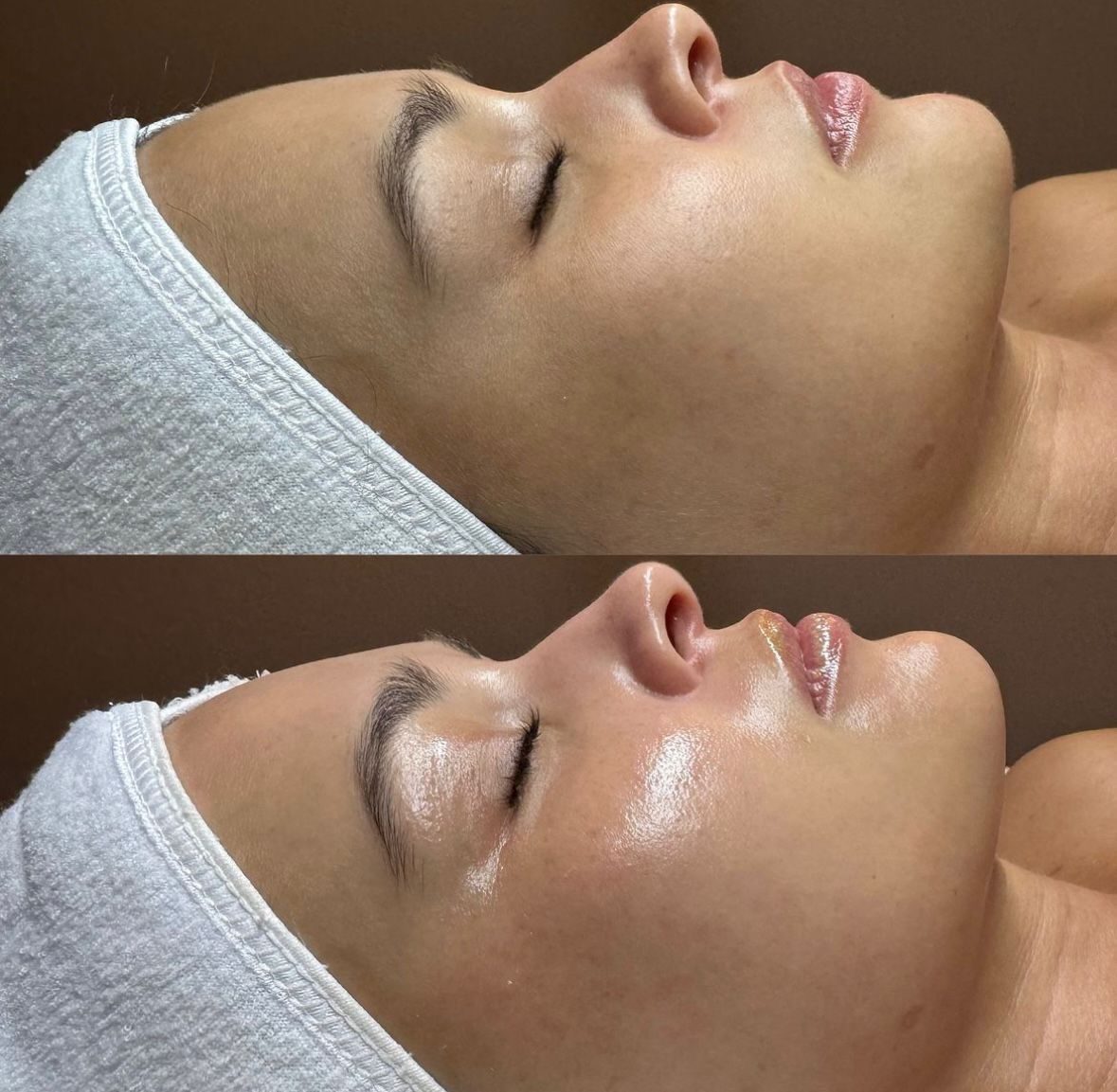 Avant après HydraFace (soin type Hydrafacial) — éclat et hydratation, Neuilly-sur-Seine & Paris