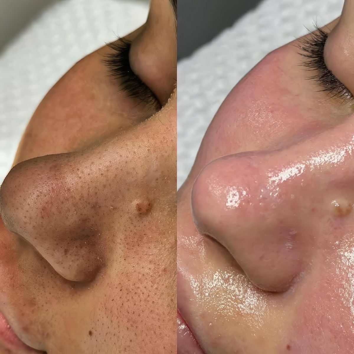 Avant après HydraFace — pores resserrés et points noirs, Neuilly-sur-Seine & Paris