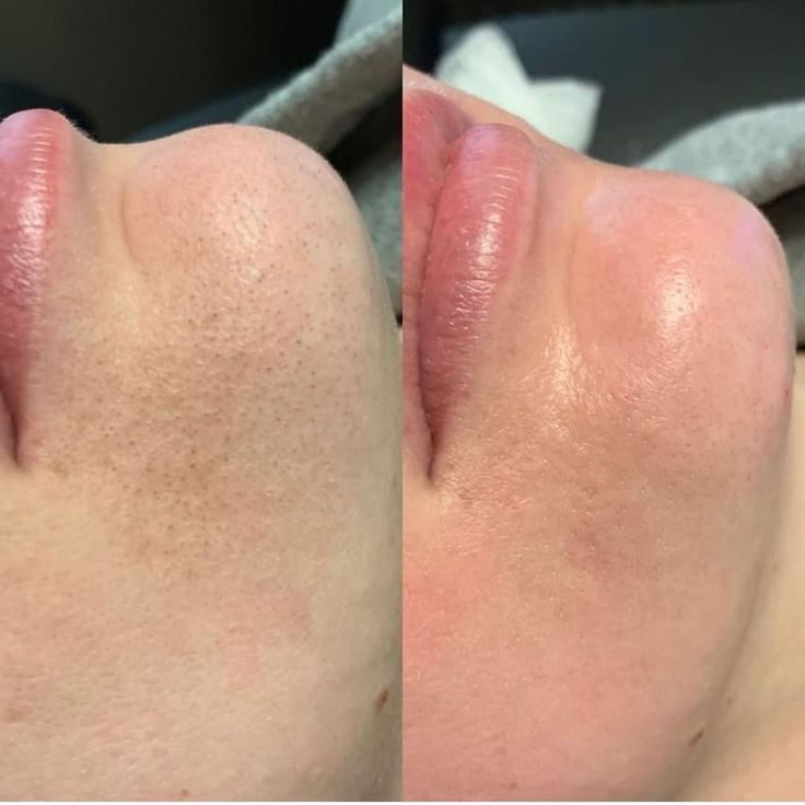Avant après HydraFace — grain de peau lissé, Neuilly-sur-Seine & Paris