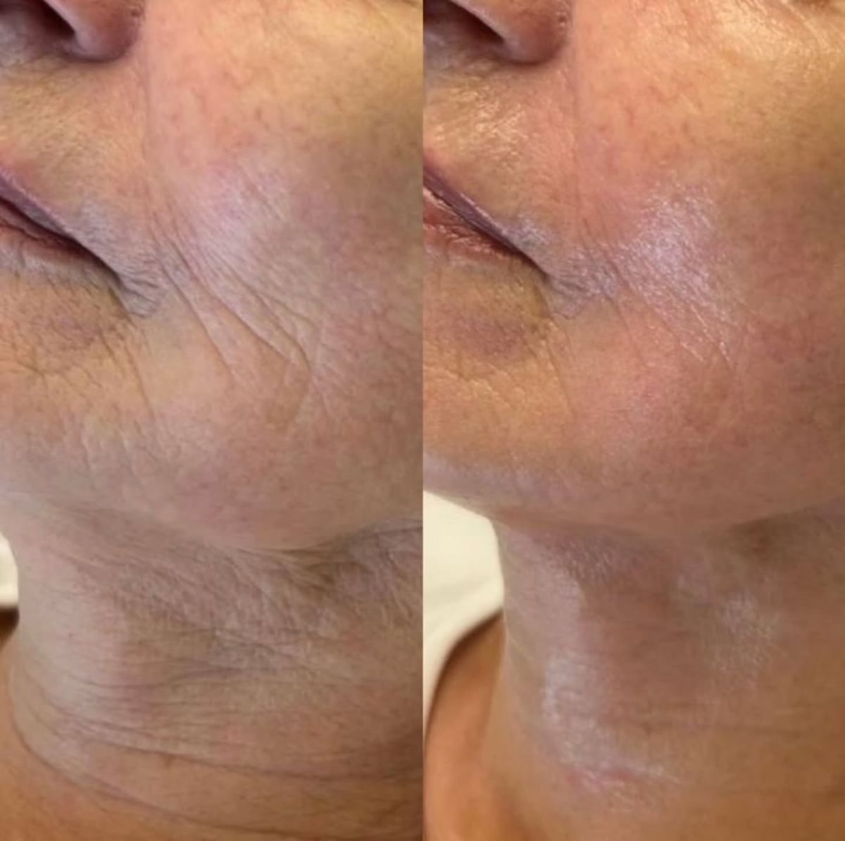 Avant après HydraFace — fermeté ovale et cou, Neuilly-sur-Seine & Paris