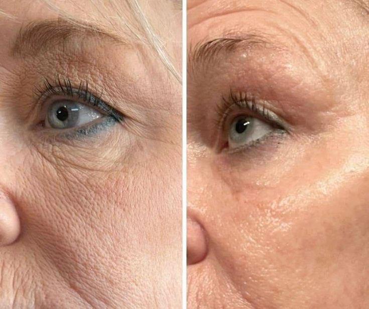 Radiofréquence contour des yeux avant après — rides de la patte d'oie lissées et regard reposé, Neuilly-sur-Seine & Paris