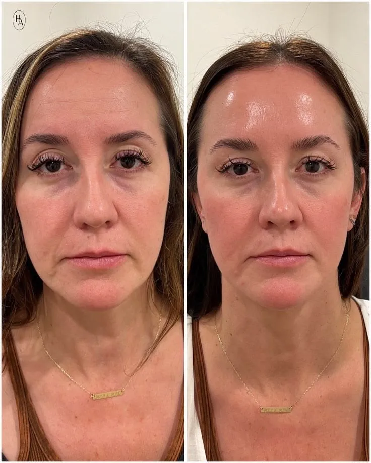 Résultat avant / après — lifting manuel du visage, Studio Anaj Neuilly-sur-Seine & Paris