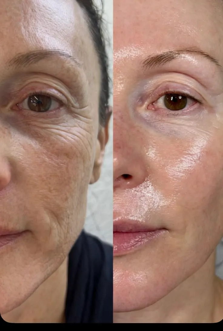 Résultat avant / après — contour des yeux (cernes, poches), Studio Anaj Neuilly-sur-Seine & Paris