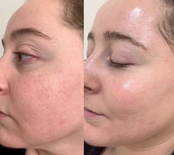 Résultat avant / après — grain de peau affiné, microneedling, Studio Anaj Neuilly-sur-Seine & Paris