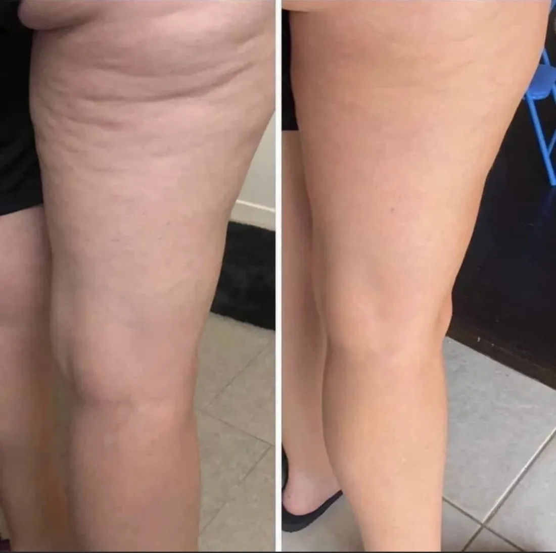 Résultat avant / après — cellulite des cuisses, Studio Anaj Neuilly-sur-Seine & Paris