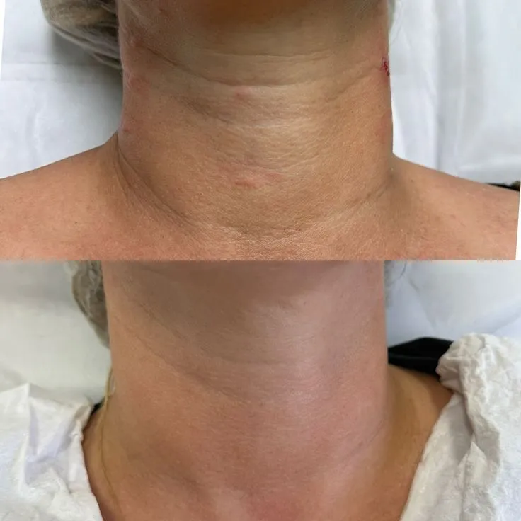 Résultat avant / après — soin du cou & décolleté, Studio Anaj Neuilly-sur-Seine & Paris