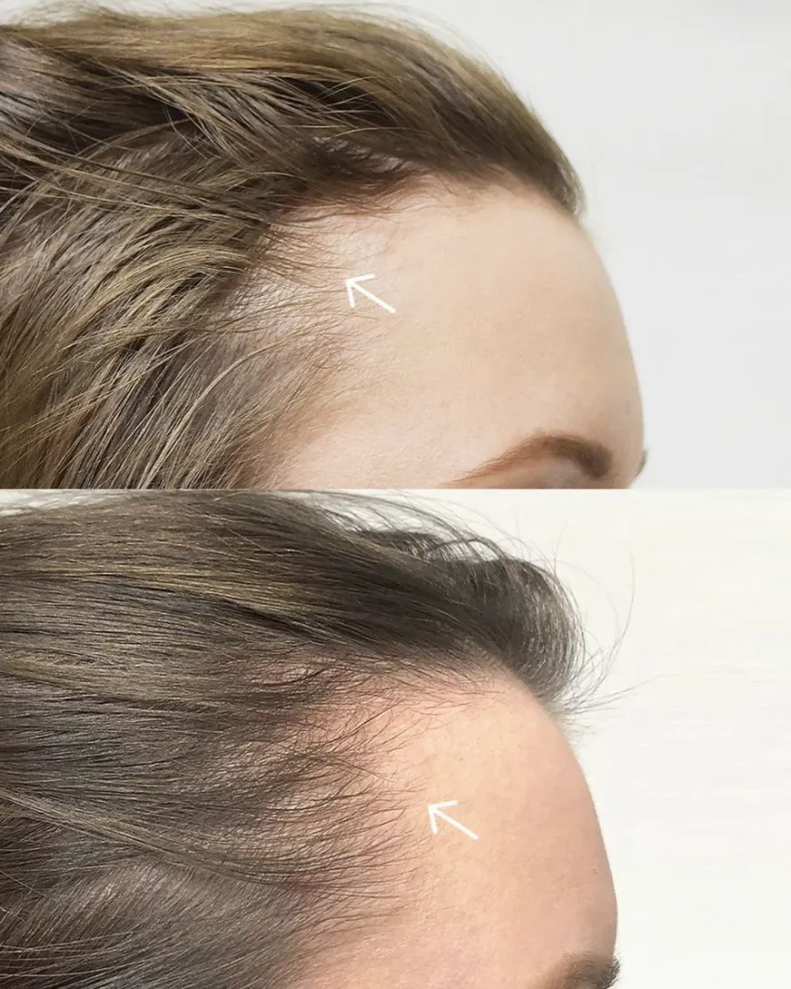 Résultat avant / après — densité capillaire, Studio Anaj Neuilly-sur-Seine & Paris