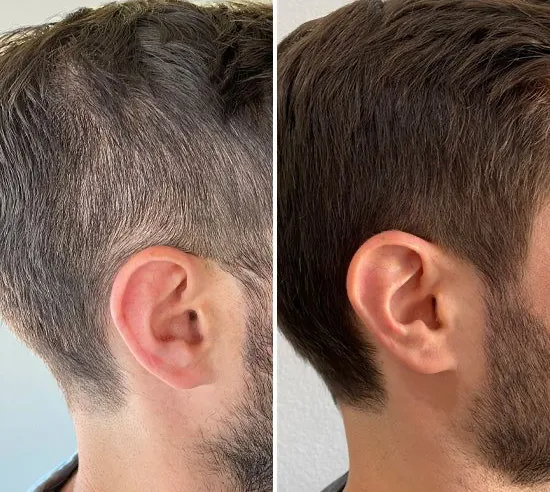 Résultat avant / après — densité des cheveux homme, Studio Anaj Neuilly-sur-Seine & Paris