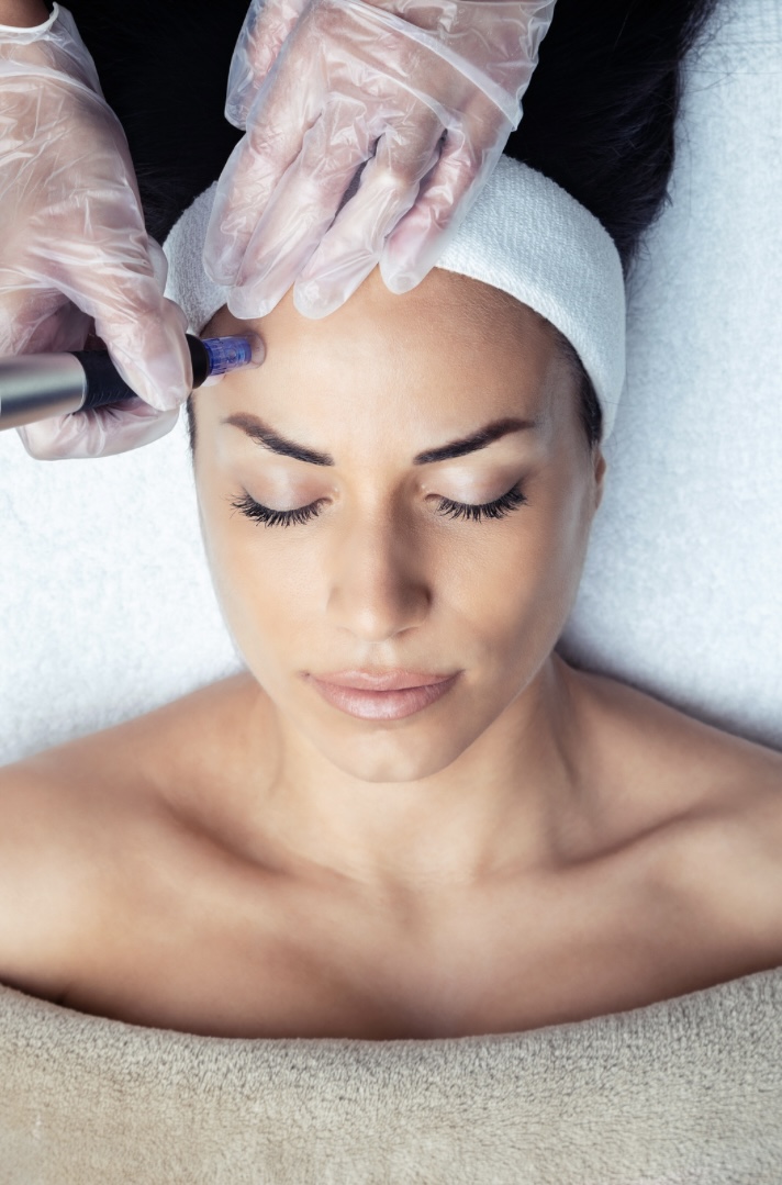 Microneedling